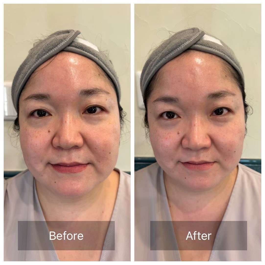 エクソソームミラクルショット