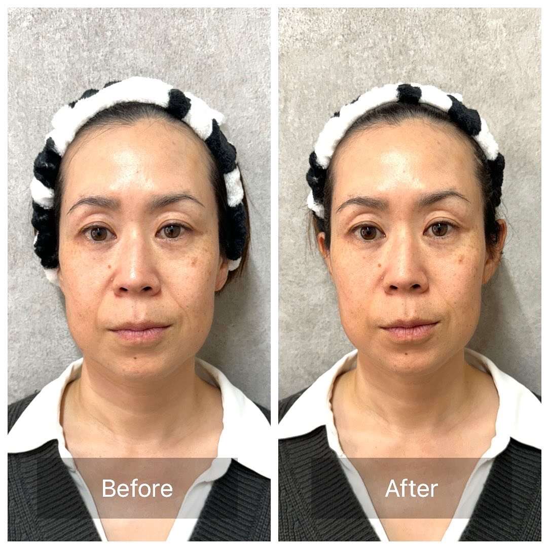 お肌をリフトアップ